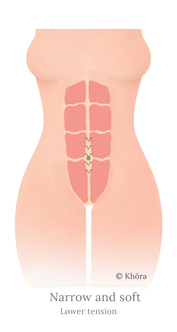 Can Diastasis Recti Be Healed? What Actually Matters More Than The Gap ...