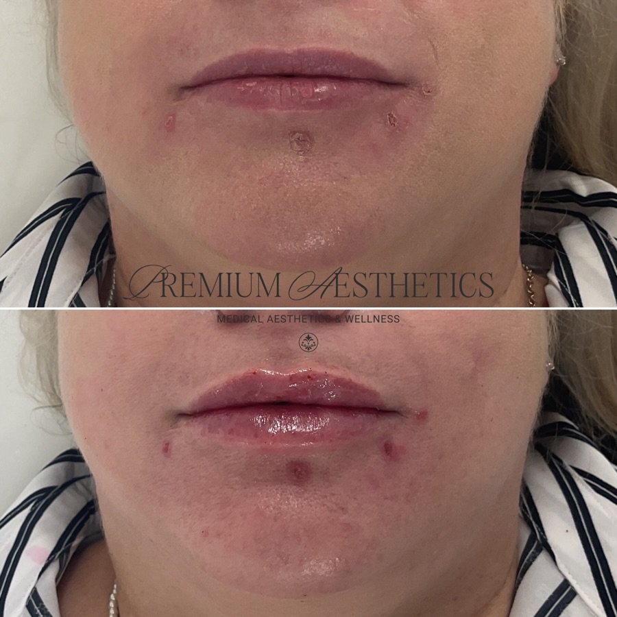 Kiss-mas ready💋🎄

Natural, subtle, hydrated, and oh so pretty❤️
&bull;
&bull;
&bull;
#nurseinjectortoronto #lipfillermarkham #lipfillersubtle #lipfillerscarborough #lipfillernorthyork #fillersgta #lipsoftheday #nurseinjectormarkham #fyp