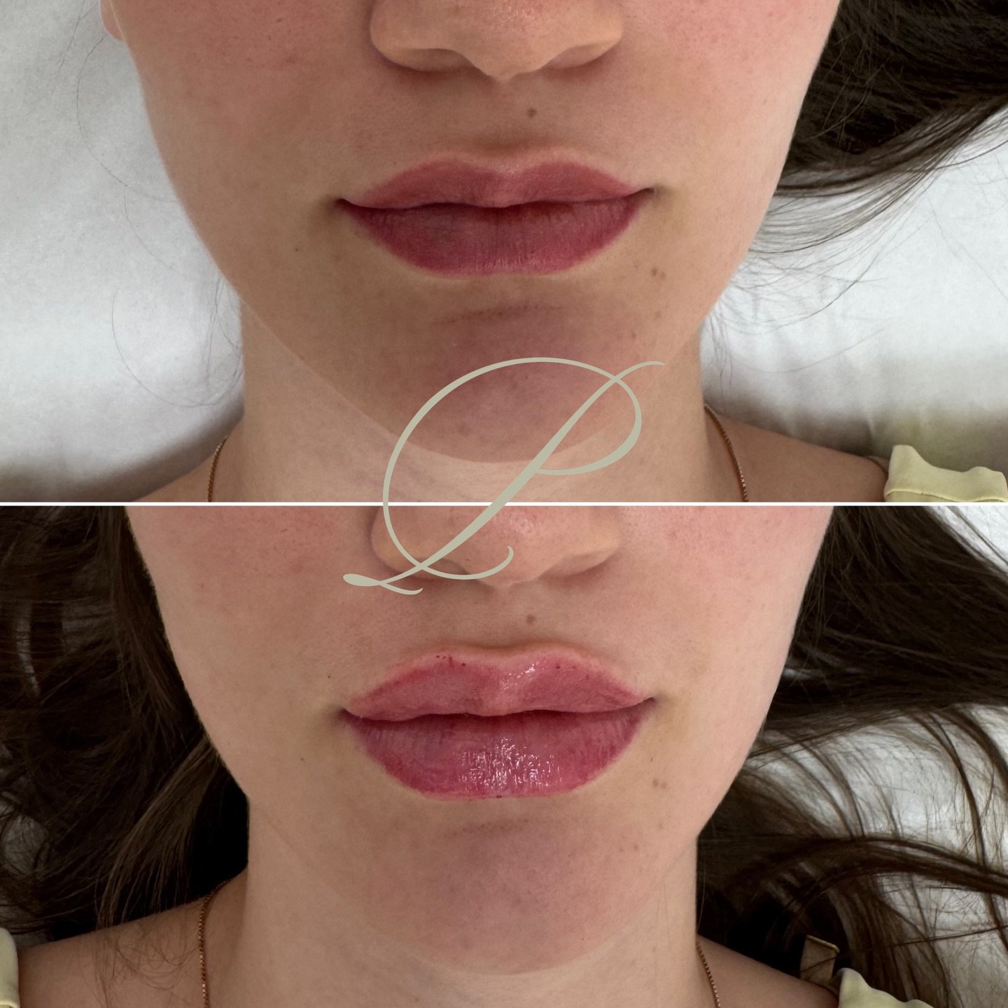 Your perfect pout is one booking away😘
&bull;
&bull;
Limited openings during the holidays, book your appointment today💝

#lipfillerbeforeandafter #lipfillertoronto #lipfillermarkham #naturallips #naturalliptoronto #lipfillerinjector #lipfillerinjec