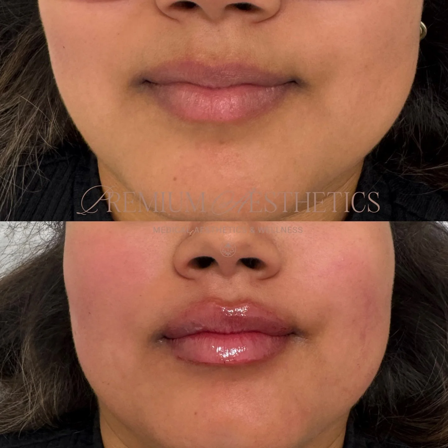 Lip goals unlocked 🔓 

Adding volume, hydration and definition to the lips - enhancing not changing✨ 

Thinking about lip filler? Every treatment starts with a custom consultation💝
&bull;
&bull;
&bull;
#naturalenhancement #subtlelips #lipgoals #lip