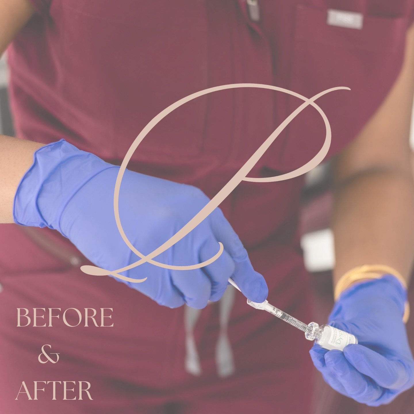 Smooth where it matters✨ 

Just a touch of tox to smooth the upper face and bring everything back to life🫰🏽
&bull;
&bull;
&bull;
Spots open this month! Book using link in bio🔗 
#nurseinjectorscarborough #nurseinjectormarkham #nurseinjectornorthyor
