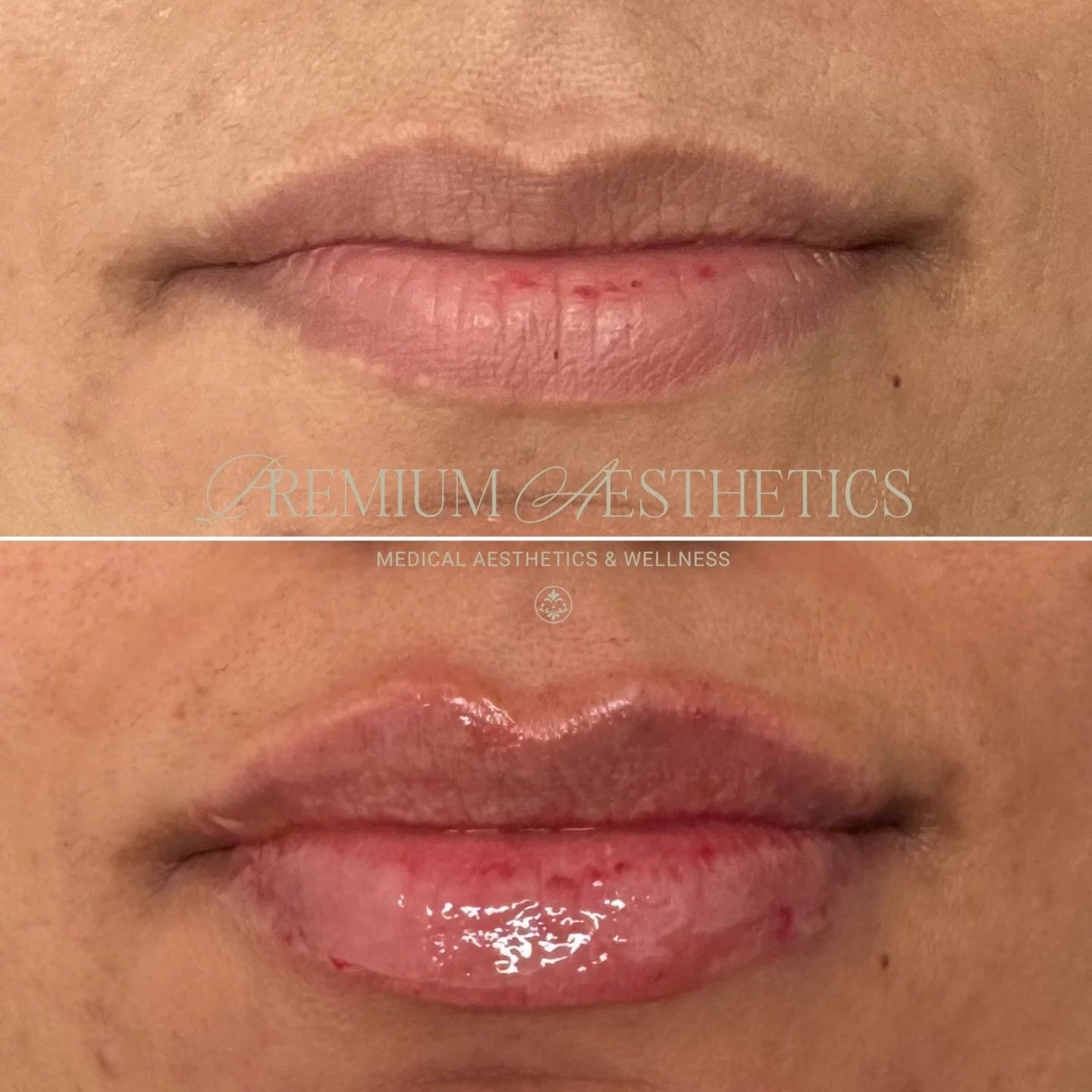 Here&rsquo;s your Monday pick me up🫦

A little bit of everything - hydration, definition and volume! 
&bull;
&bull;
&bull;
Secure your refresh - online availability updated, link in bio💌
#nurseinjectornorthyork #nurseinjectorscarborough #lipfillerm