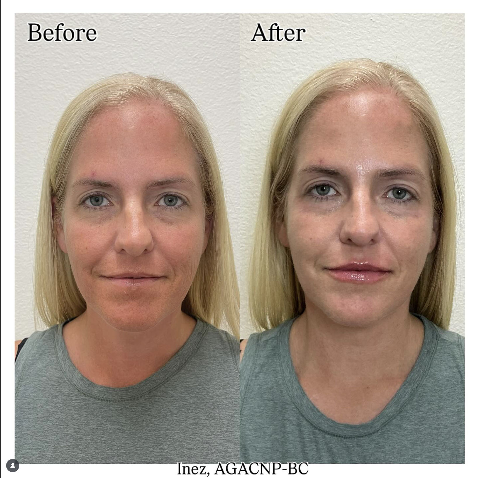 Ended the week giving my patient subtle, natural lip filler results using Juvederm Vollure. Love how it turned out!
by Inez (@inez.aesthetics)