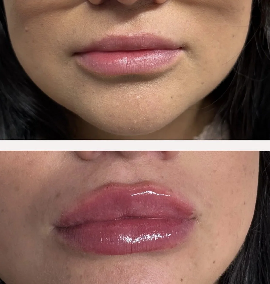Custom Lip Plump