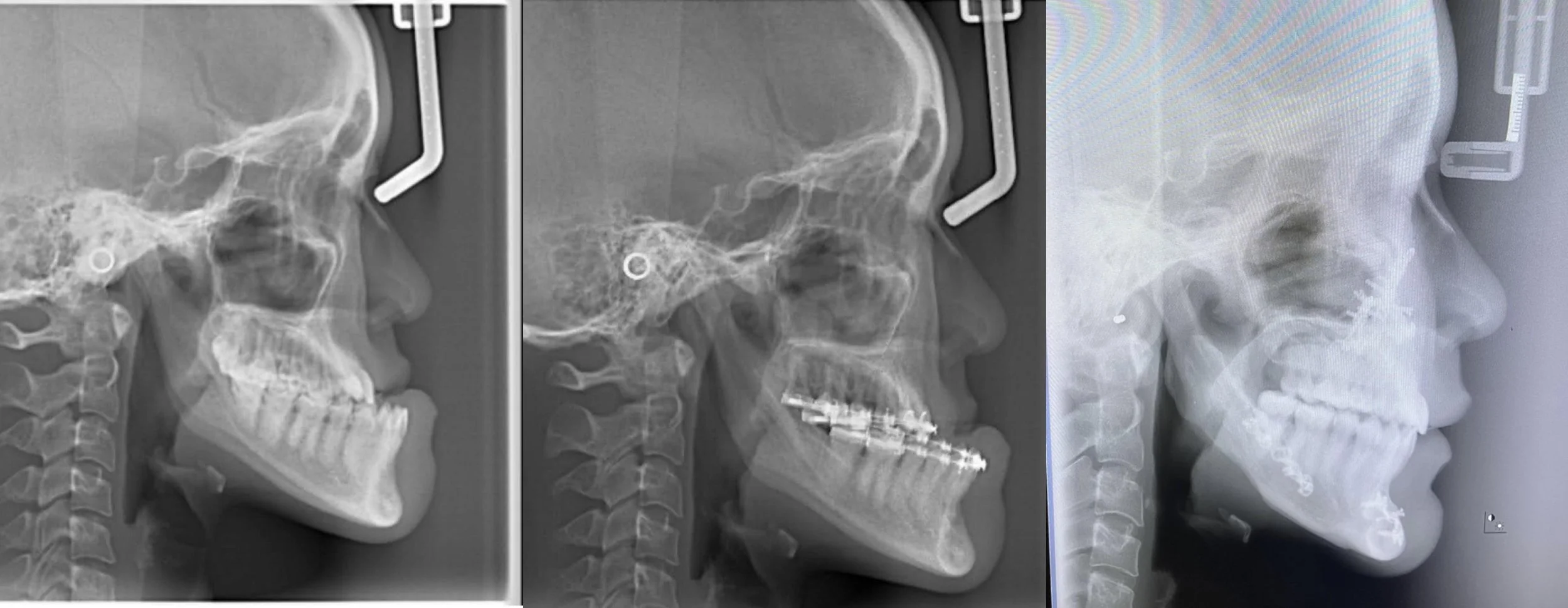 Early Orthodontic Treatment vs Jaw Surgery: Why Timing Matters