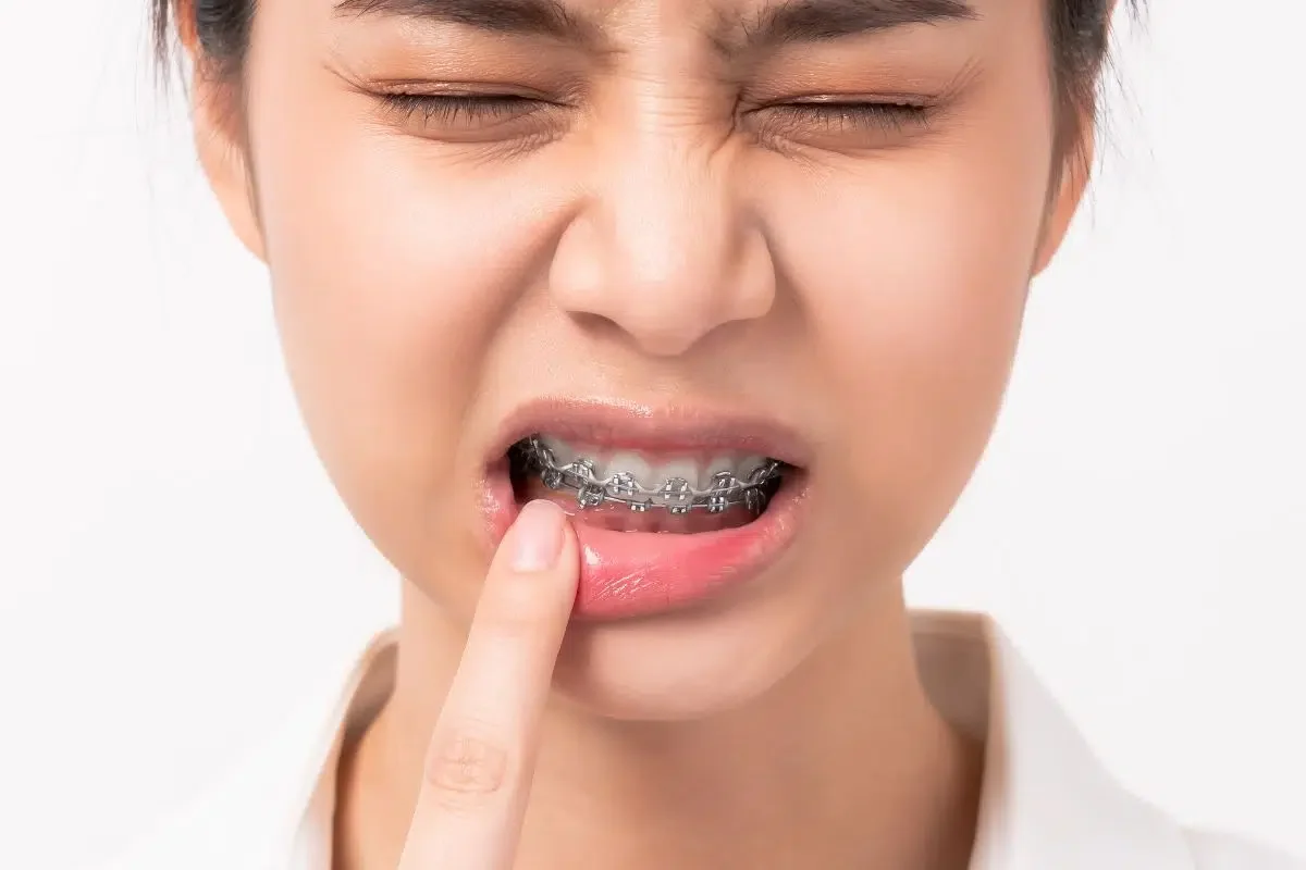 What to Do If Your Braces Break