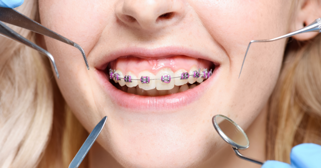 How Long Does Orthodontic Treatment Take?