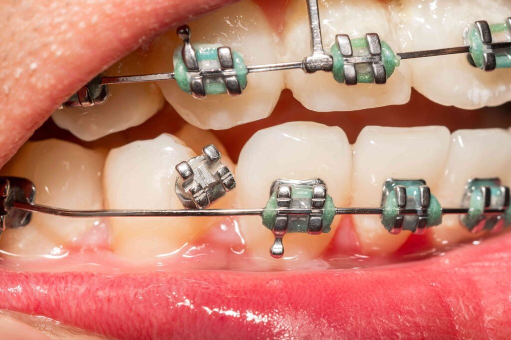 Broken braces with loose bracket and wire