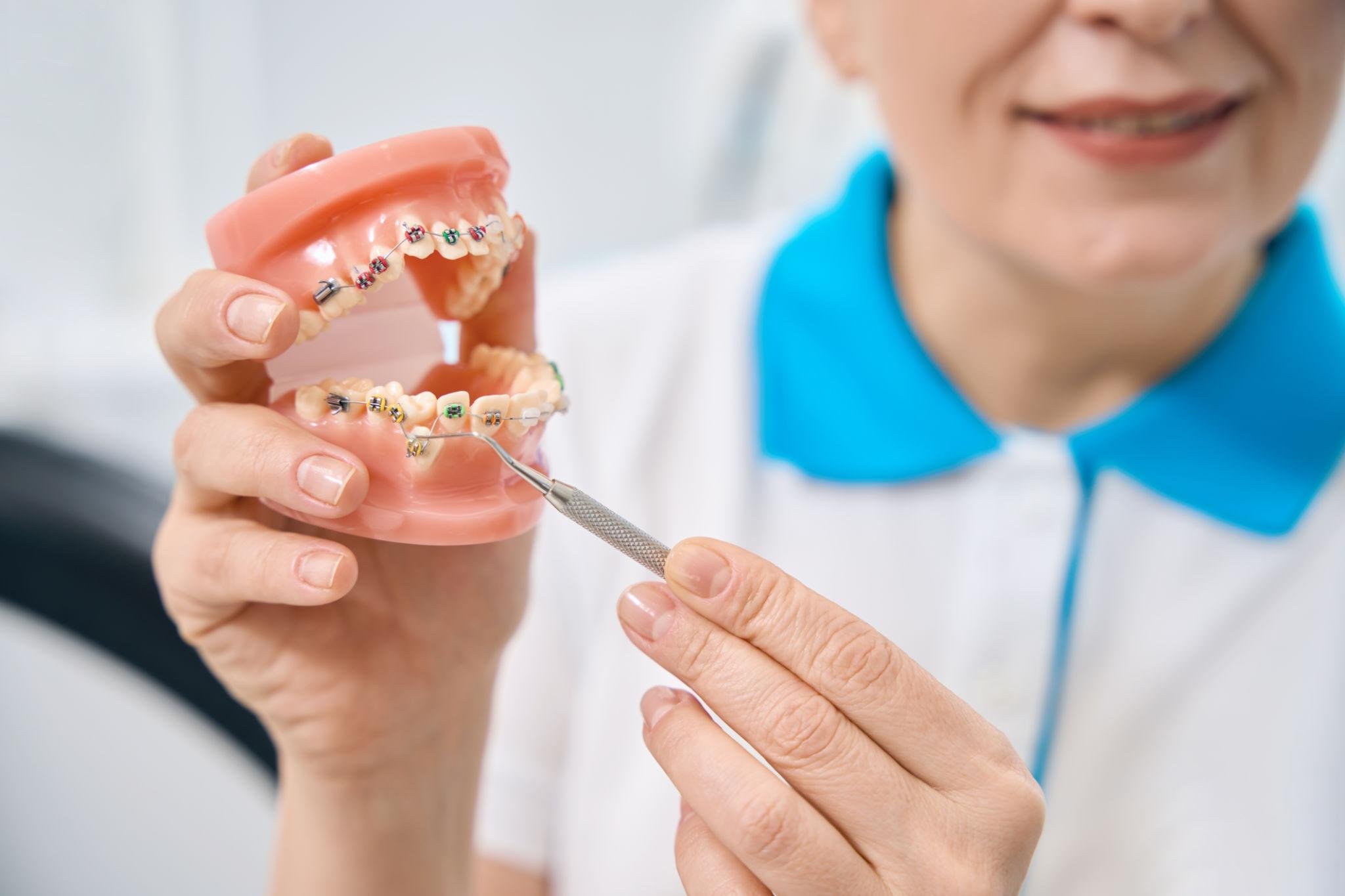 Crowded teeth caused by limited jaw space in a growing child