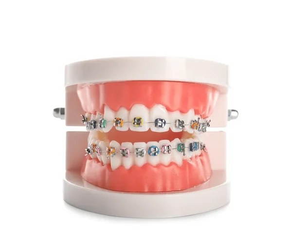 model-jaw-braces-isolated-on-600nw-2131657487.webp