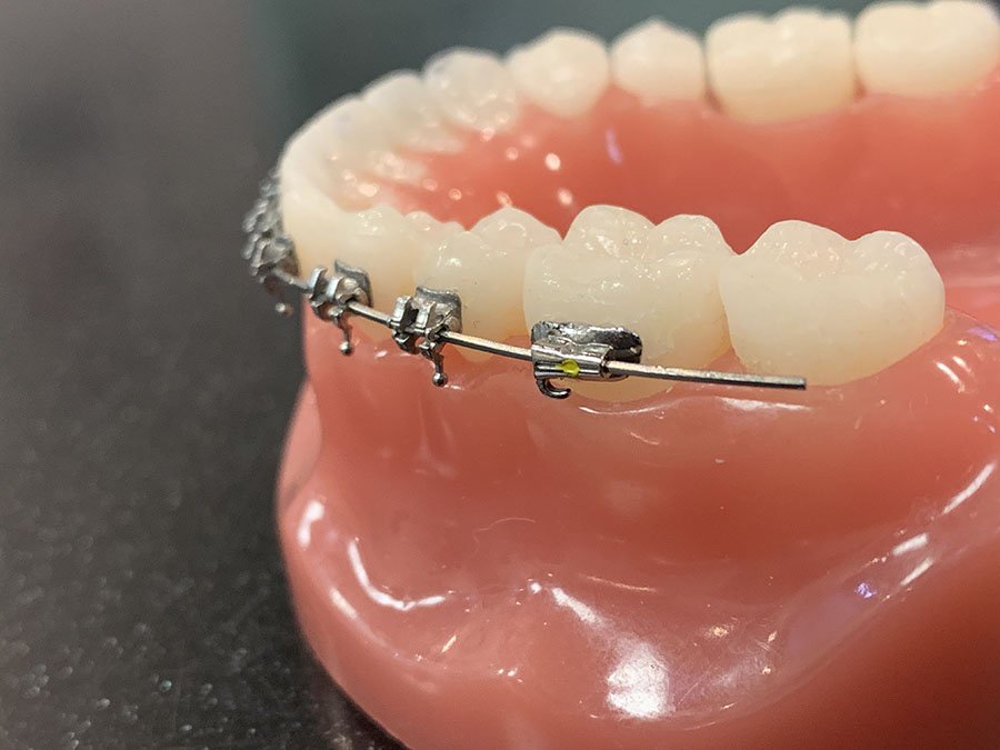 Orthodontic emergency involving poking wire