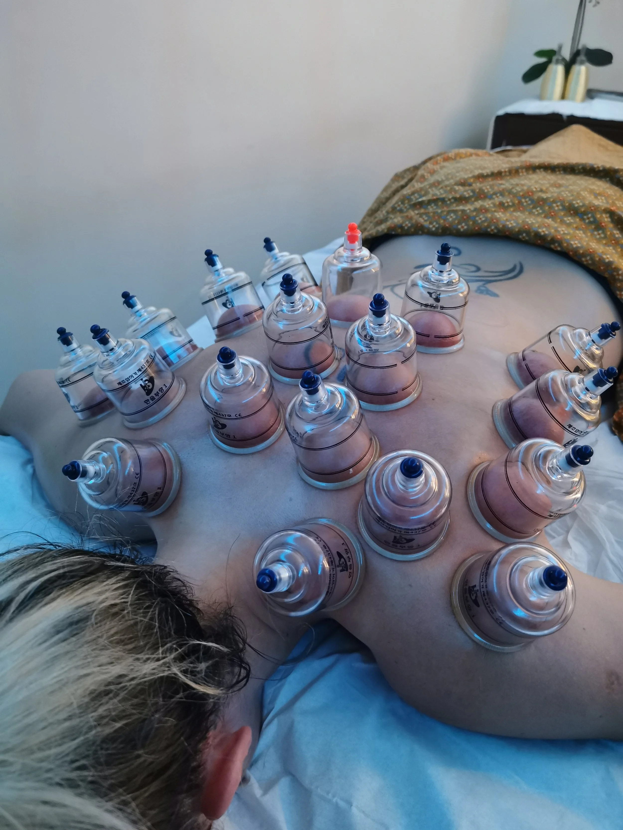 Lady faced down on a massage table with dry cups applied to the back and shoulders.