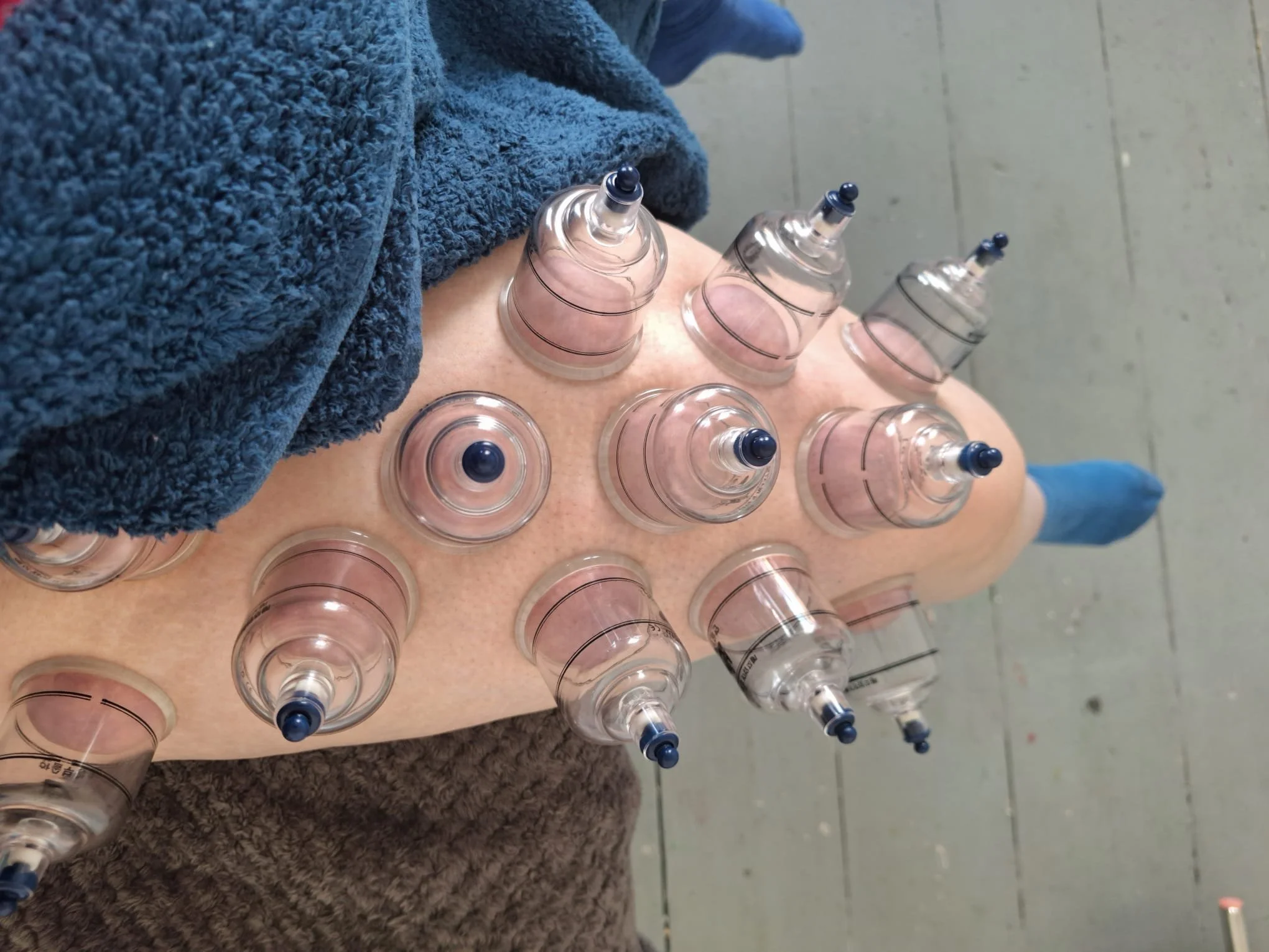 Myofascial Cupping (dry)