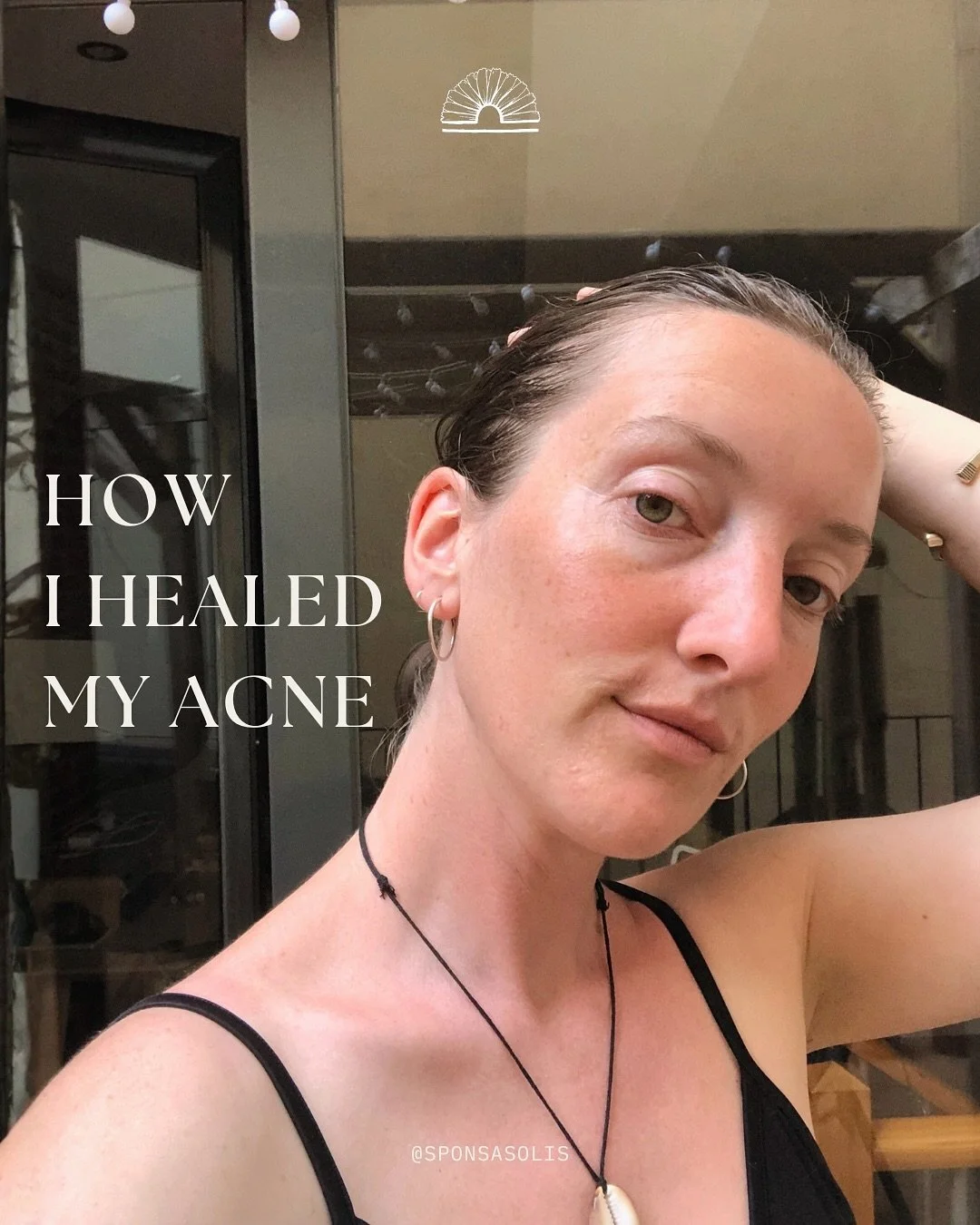 Healing my acne ❤️&zwj;🩹

I&rsquo;ve been thinking about sharing my acne story for a little while. Though it feels vulnerable to share (especially my pictures), I decided it would be a good thing to do. I remember in the depths of it that other peop