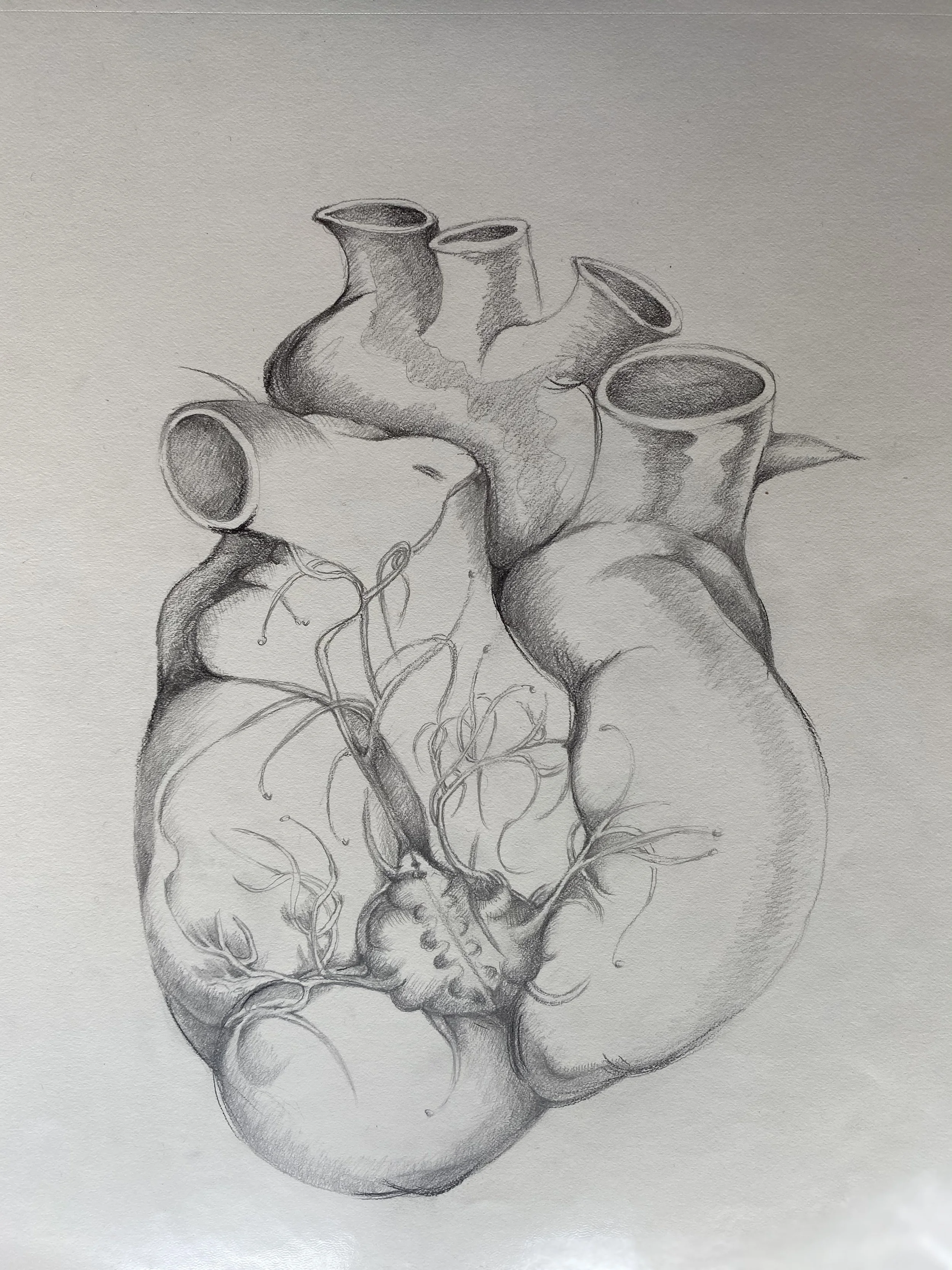 Cardiomegaly(心肌肥大)