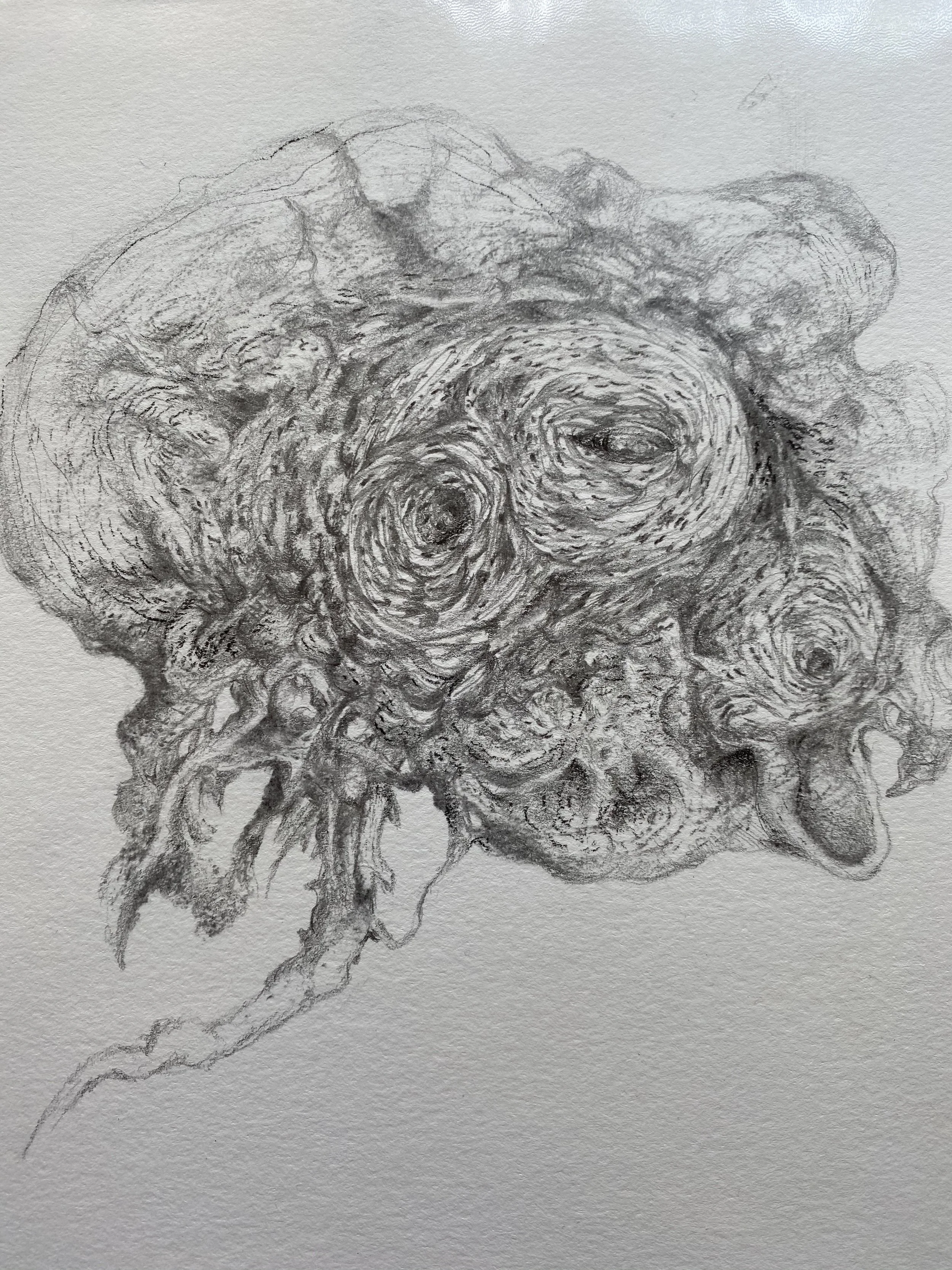 腦梗(Cerebral infarction)