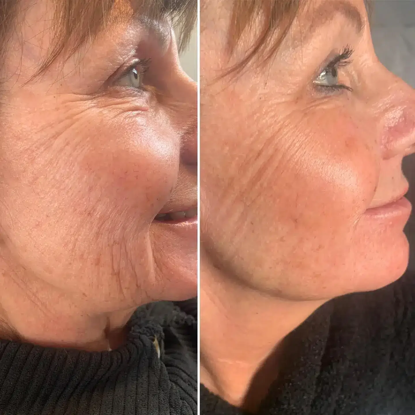 Wrinkle reduction with Stylage Hydromax Side-by-side comparison of a woman's face showing reduction of wrinkles and improved skin texture.