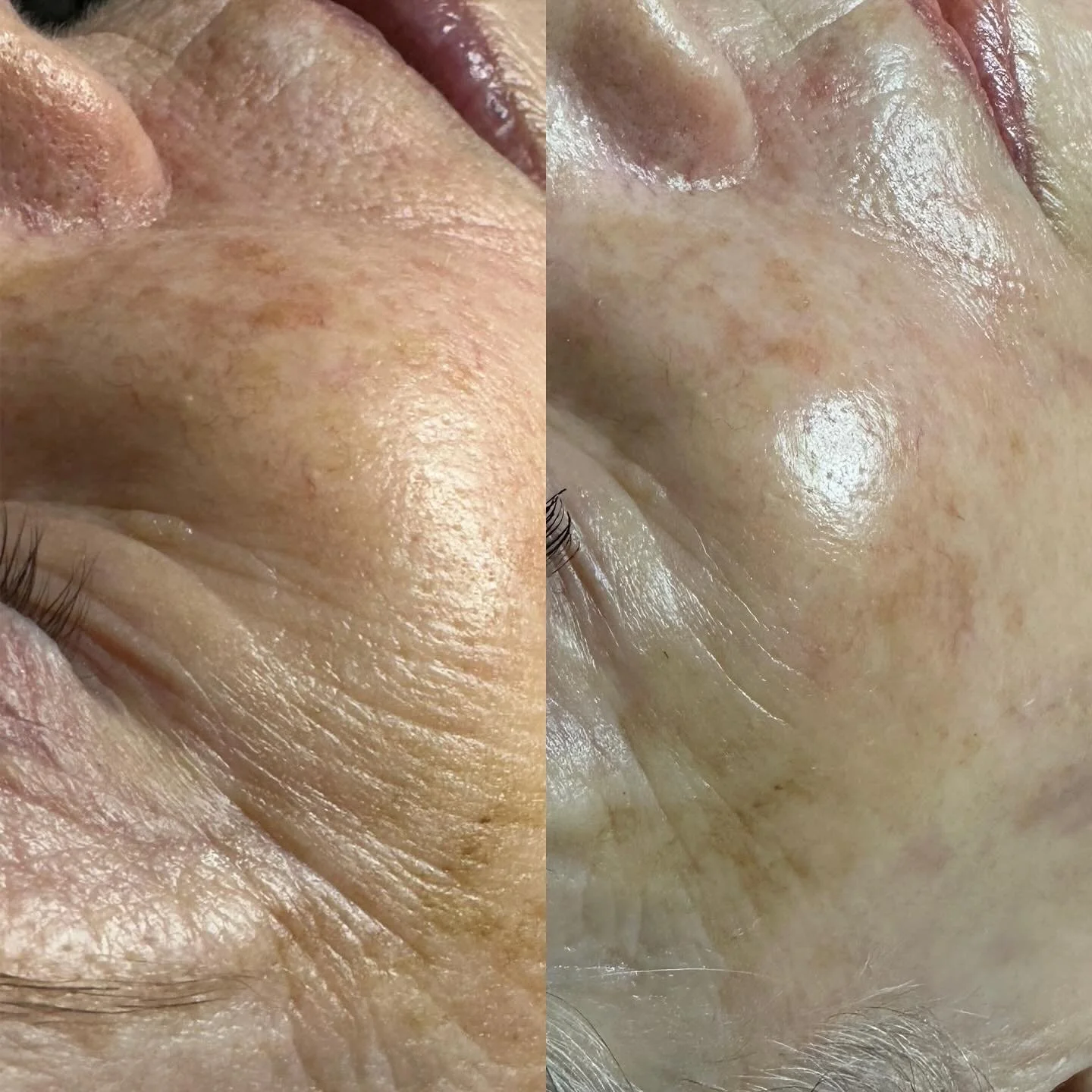 ✨ Before &amp; After Glow ✨
The results of a chemical peel speak for themselves! Whether you choose a TCA Peel, BioRePeel, or The Perfect Peel, your skin will transform&mdash;revealing a smoother, brighter, more radiant complexion.

🌿 TCA Peel helps