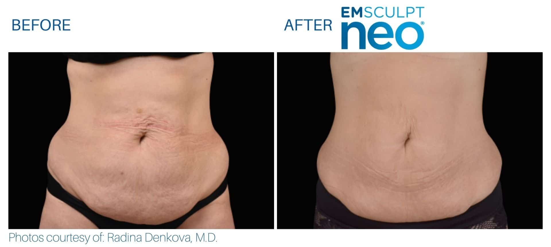 Before and after photos showing a woman's abdomen, with reduction in skin laxity and stretch marks after EMSCULPT neo treatment.