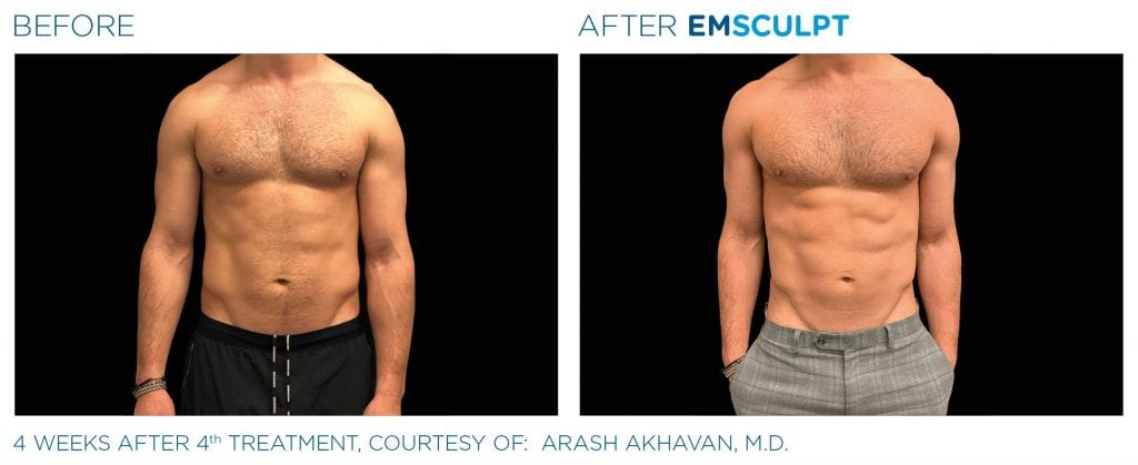 EMShape® Neo Elite often delivers similar or better results than Emsculpt at a more accessible price point, making it ideal for clients who want elite results without the elite price tag.