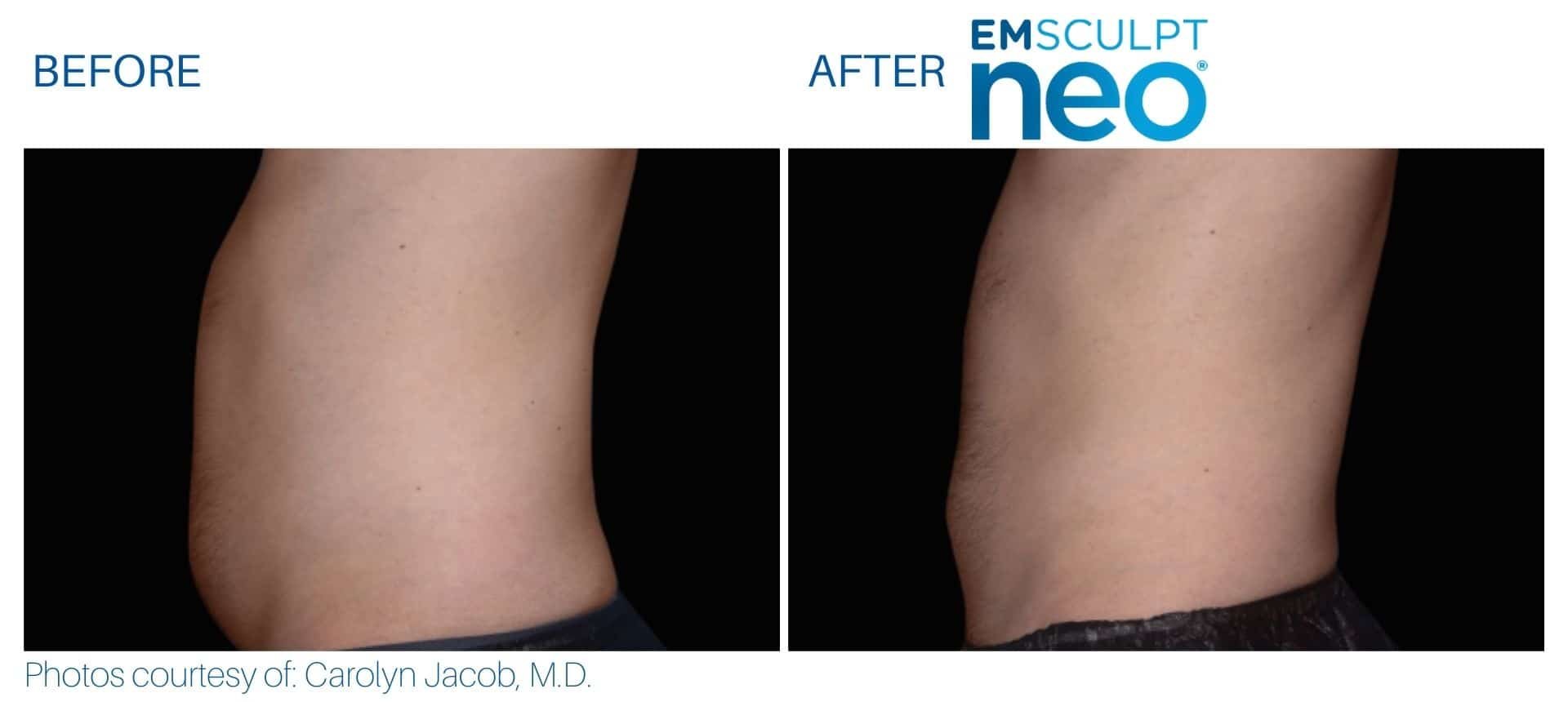 Side-by-side comparison of a person's waist showing a slimmer appearance after EMSCULPT NEO treatment, with labels 'Before' and 'After'.