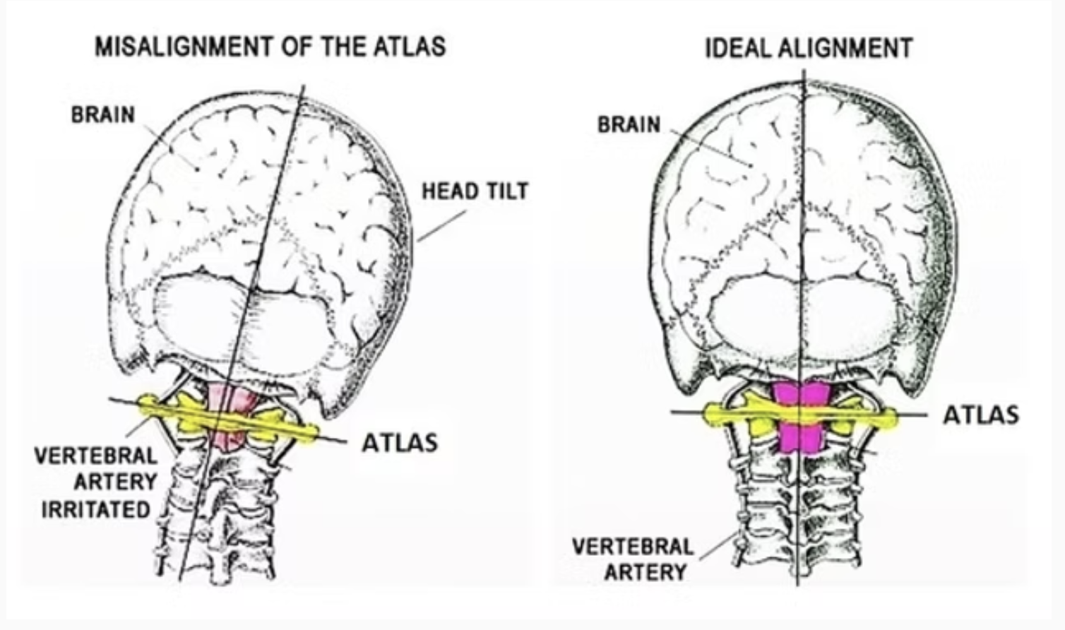 Understanding the Link Between Atlas Misalignment and Low Back Pain