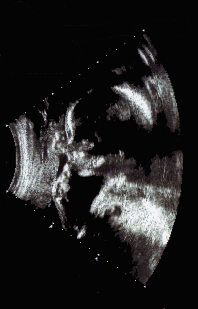 Black and white ultrasound image of a fetus in the womb, showing facial features and body profile.