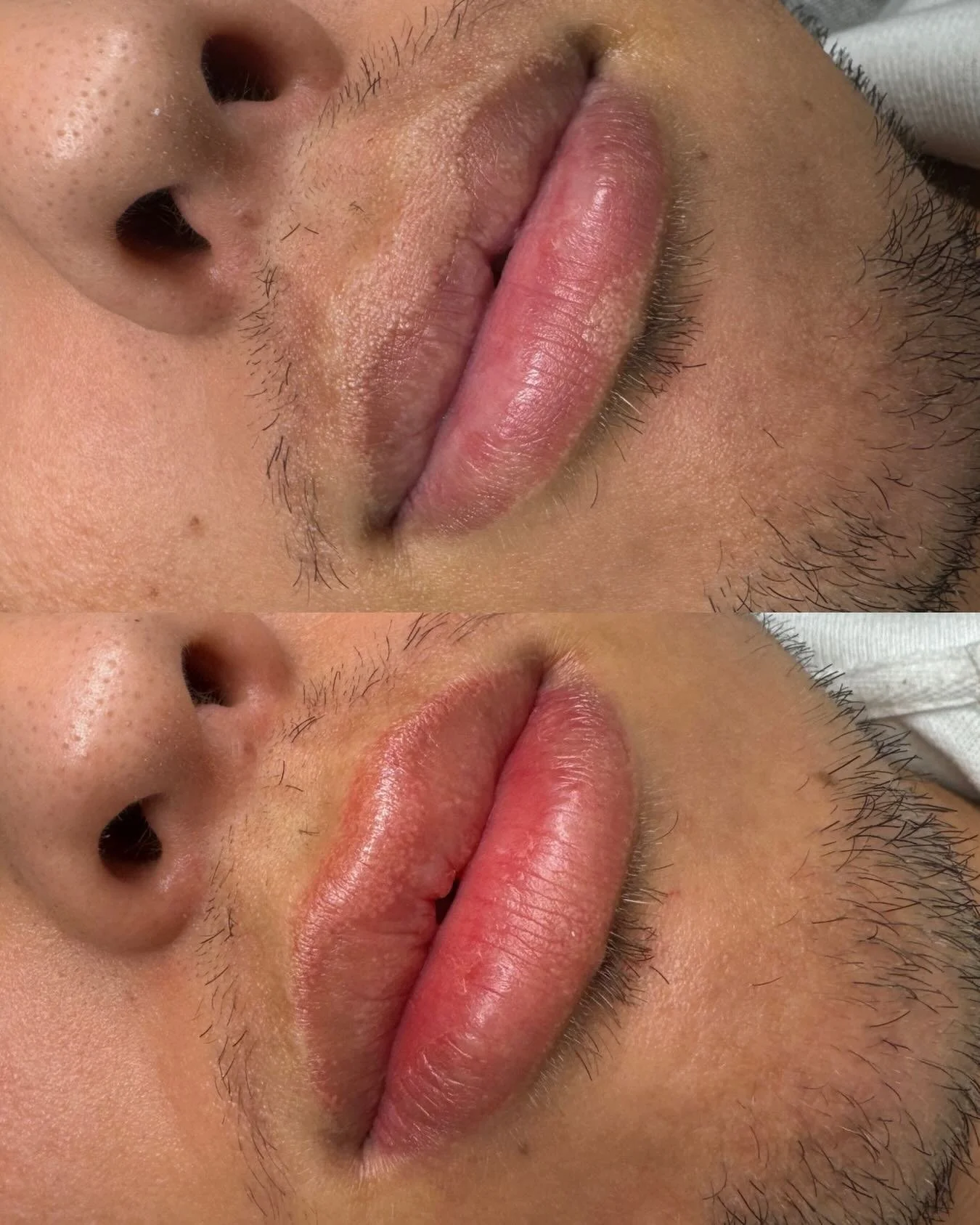 Men can benefit from PMU too 📢

This treatment was done to softly correct discoloration and a superficial lip burn, creating a more even tone while maintaining a completely natural finish. 

Color will fade 30-50%. 2-4 sessions may be required to ac
