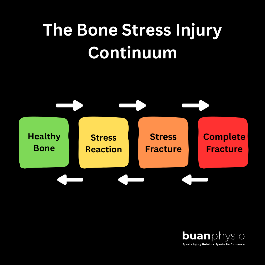 Bone Stress Injury / Fracture : A Comprehensive Rehab Guide! — buanphysio