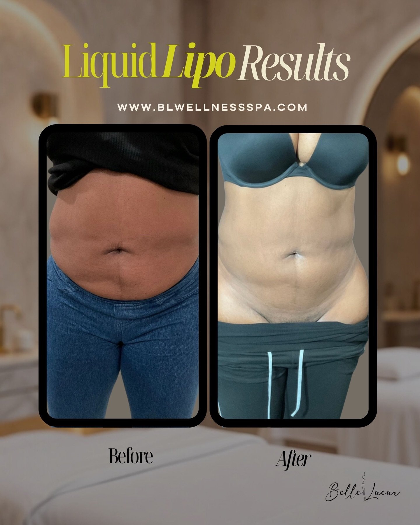Liquid Lipo Power Hour&trade; helps target stubborn pockets so your natural shape can show up more defined and balanced. The goal isn&rsquo;t smaller, it&rsquo;s snatched and sculpted. 

This is body architecture ✨ structured, medically guided, and b