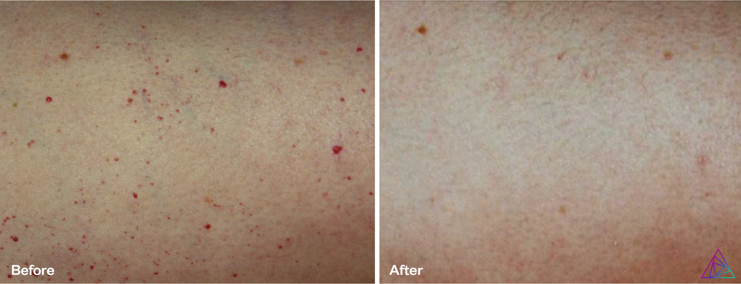 Vascular Lesion B&A_4.png