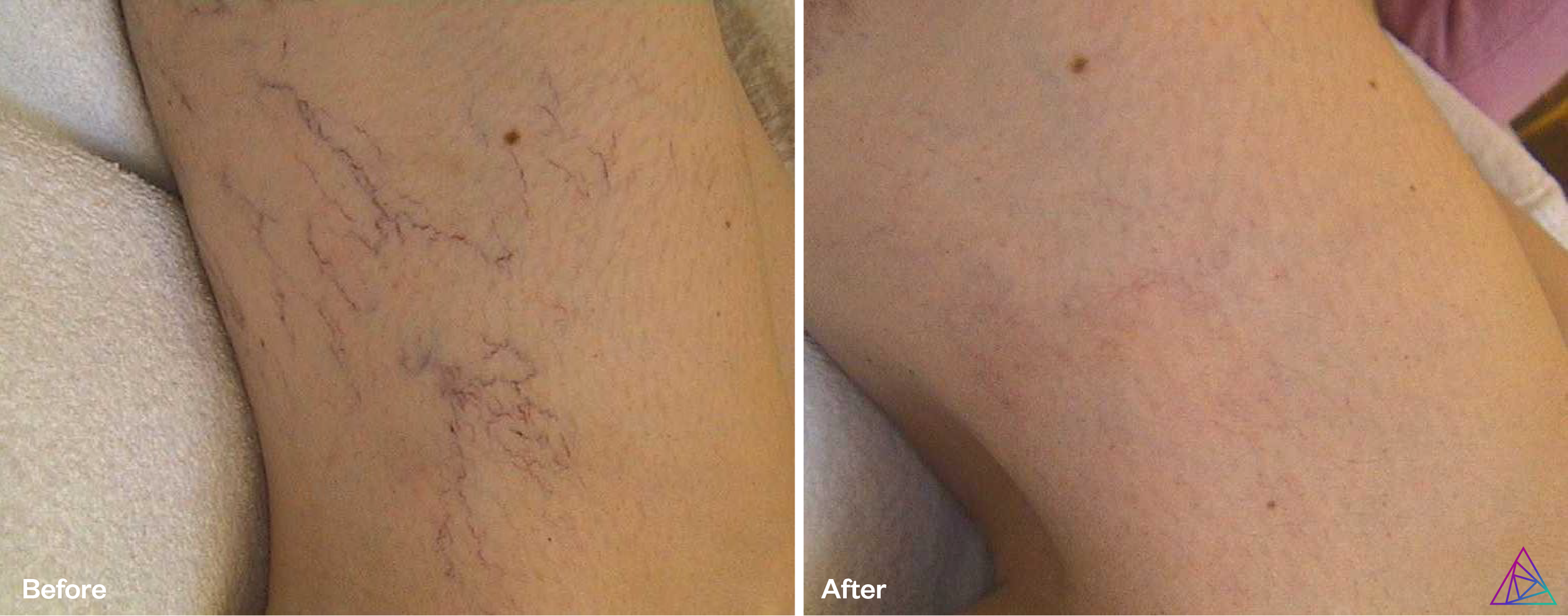 Vascular lesions ("spider veins")