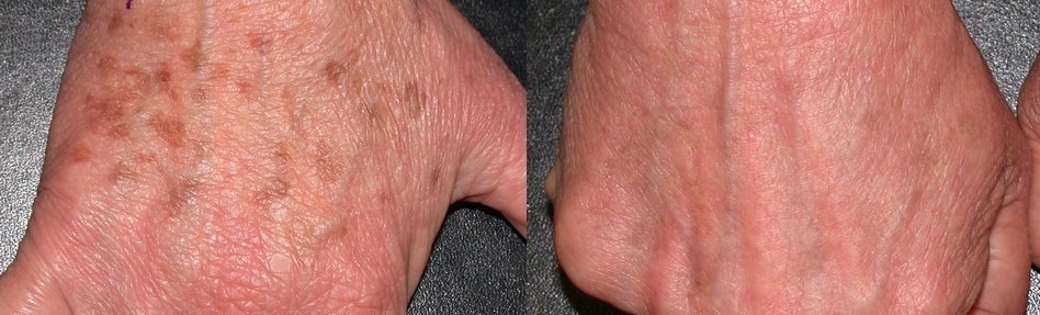 Benign pigmented lesion ("sunspots")
