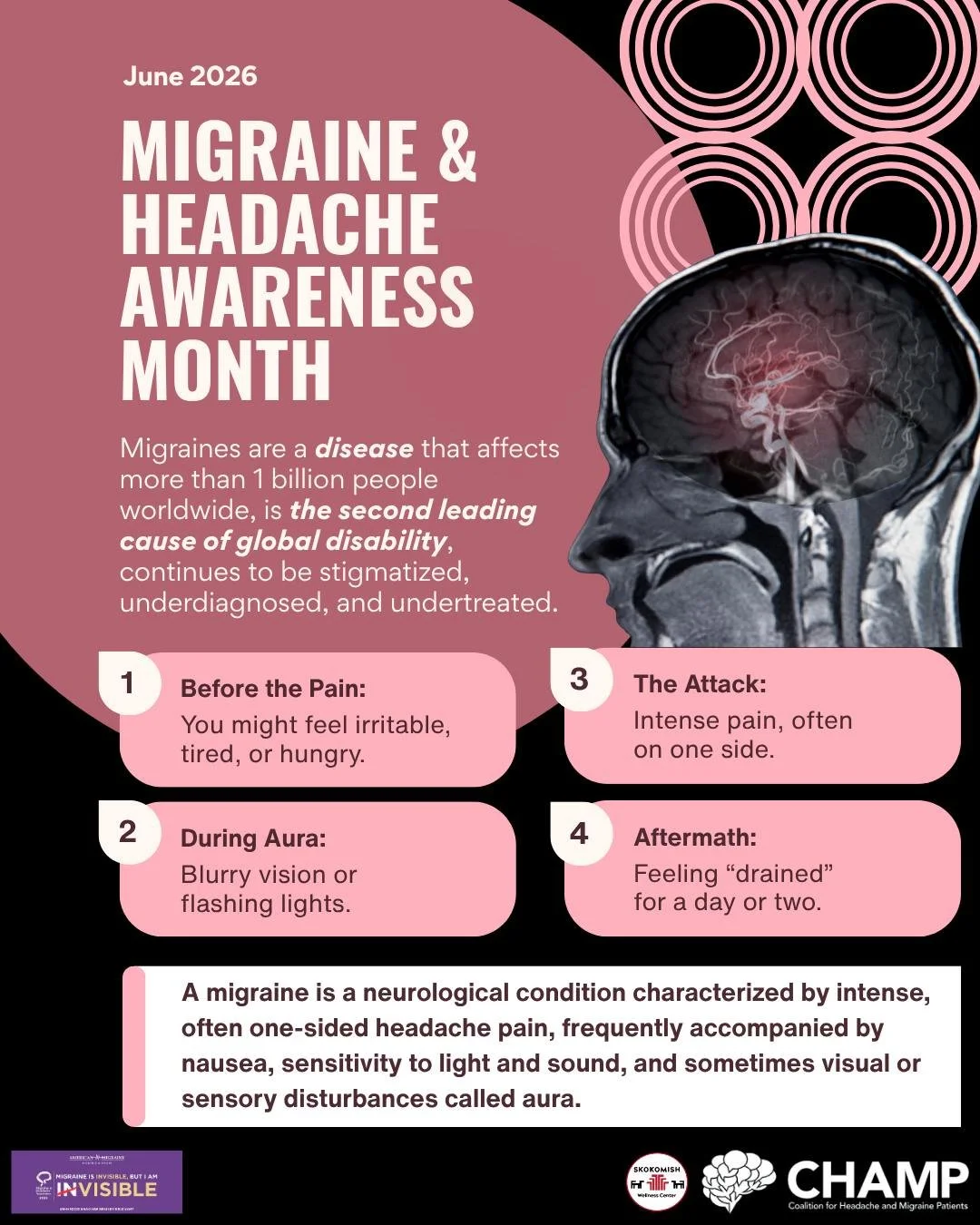 🧠🥴June is Migraine and Headache Awareness Month⚡🧠
Millions of people live with migraine, a complex neurological condition that can affect work, family life, school, and everyday activities. Because symptoms are often not visible to others, many in