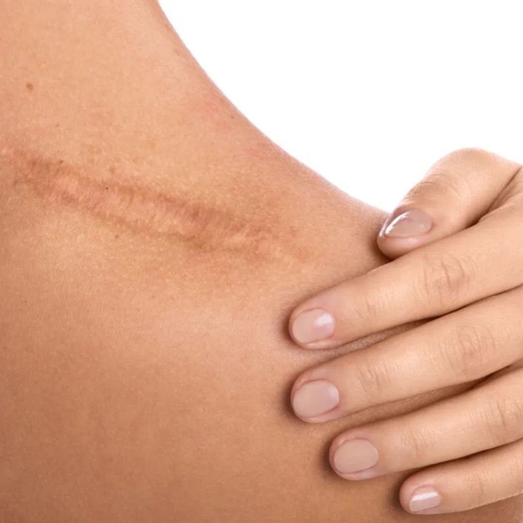 Scar Tissue and Post-Surgical Recovery