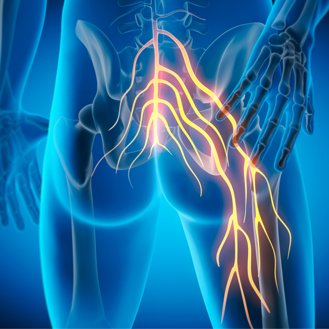 sciatica diagram showing where the nerves are affected in the lower back and hips