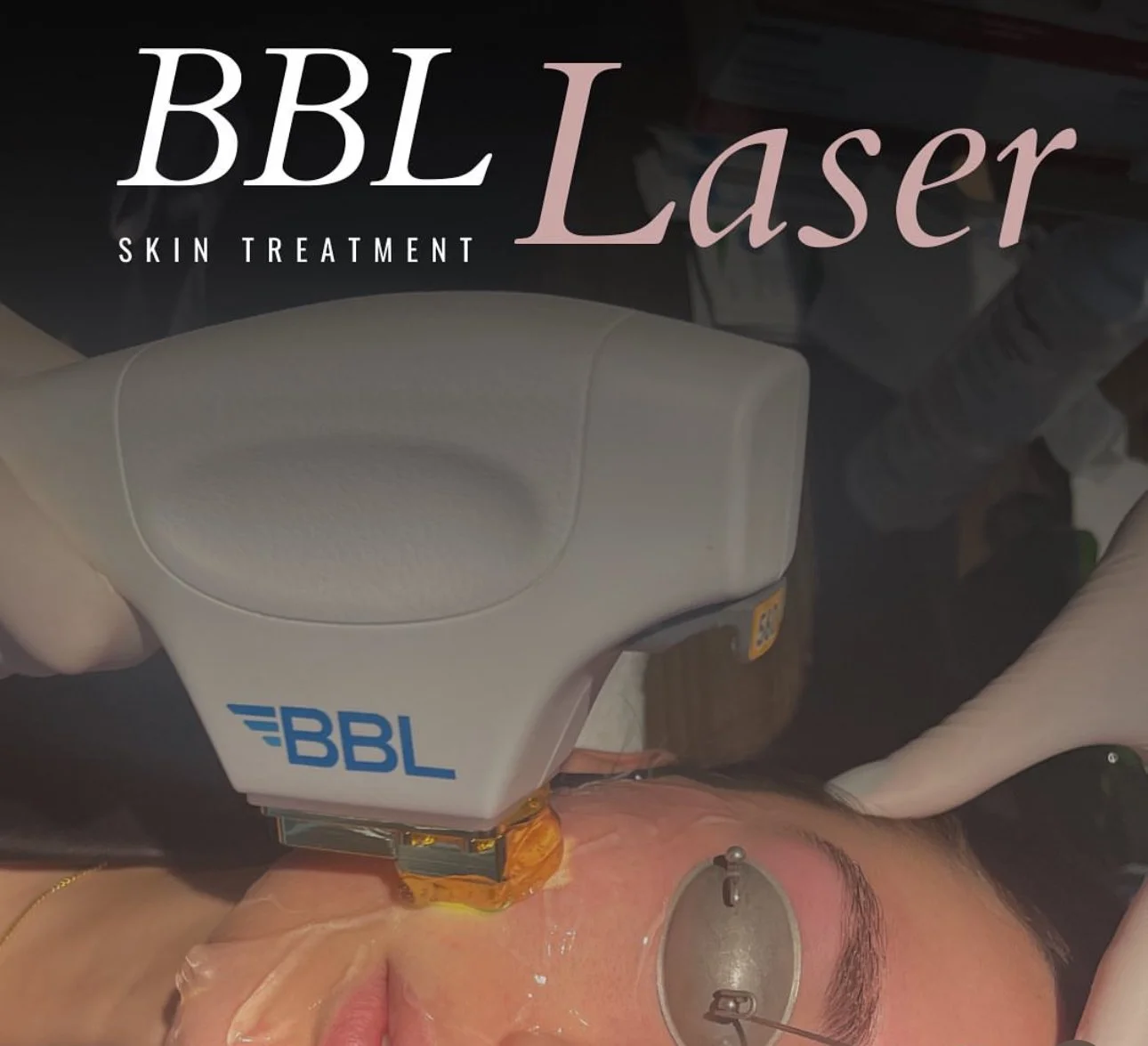 BBL Laser Treatment.jpg