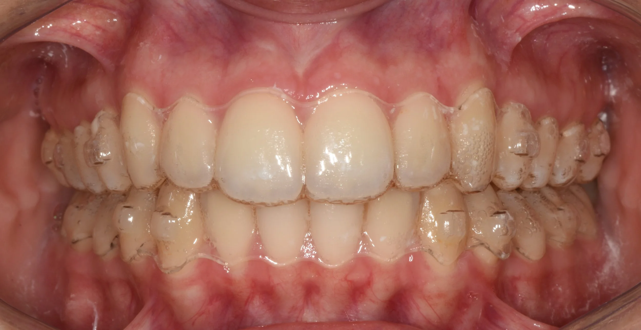 Foto di allineatori trasparenti.JPG