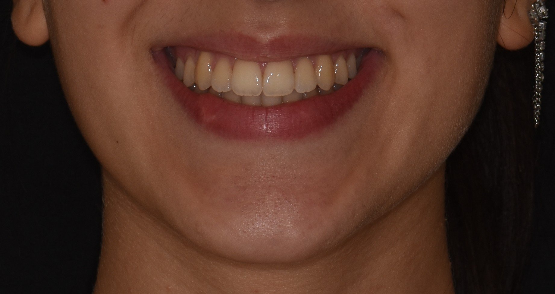 Foto di sorriso post trattamento ortodontico.JPG