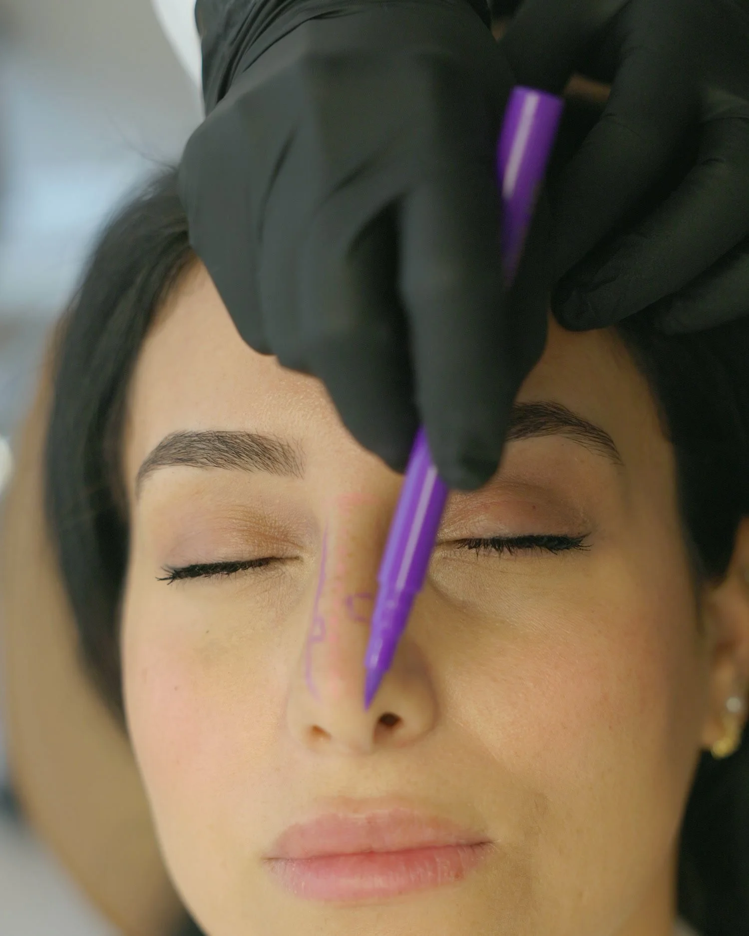 Nose being marked before a non-surgical rhinoplasty at Luníc in Ottawa