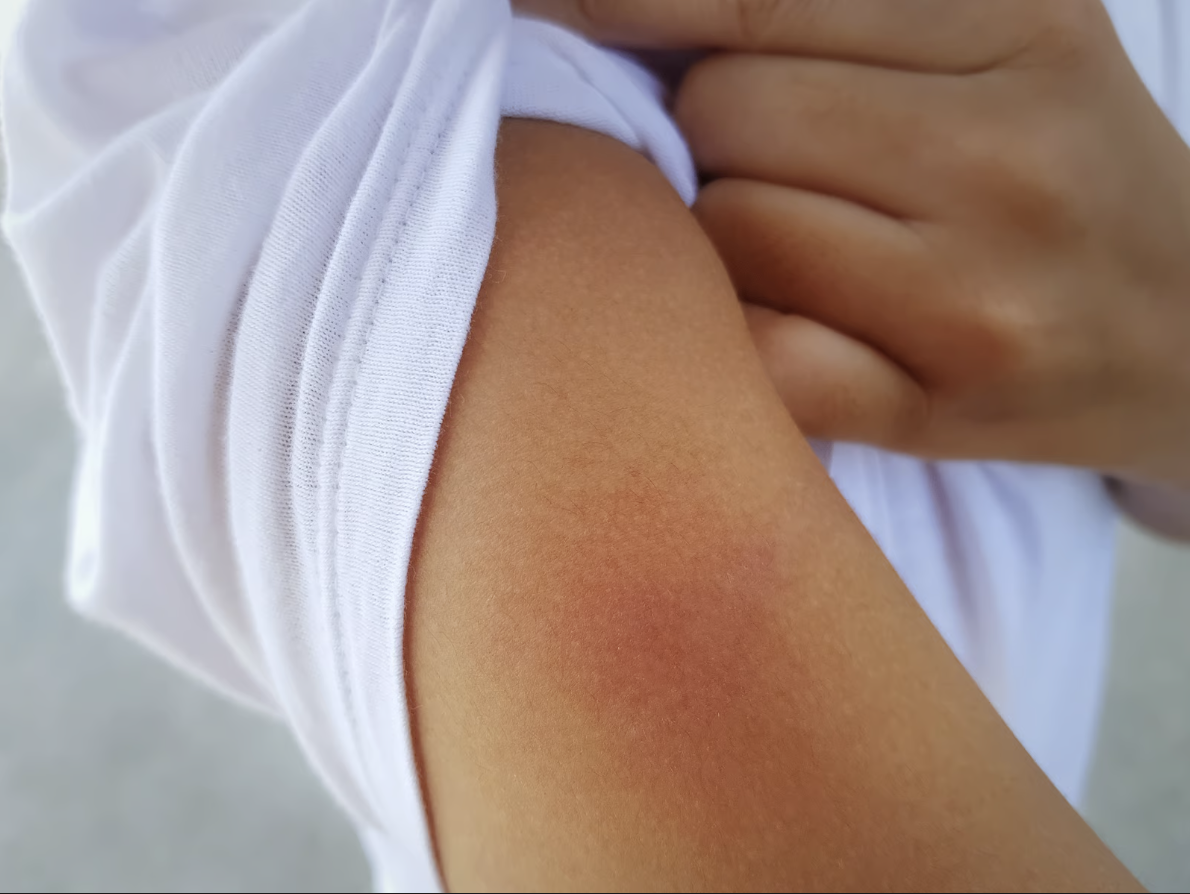 A close up of an arm with an insect bite.