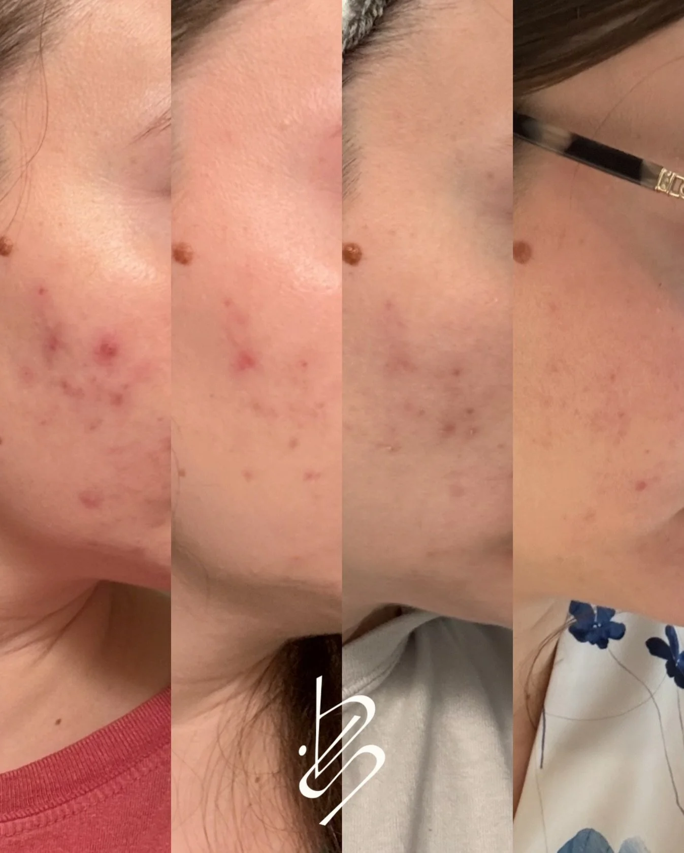 Acne CAN clear 🤍✨

This is 12 weeks of consistency, commitment, and trusting the process.

4 treatments.
Morning + night homecare.
No skipping. No guessing.

She was also coming off birth control during this time (hello hormone shifts 🙃) and still 
