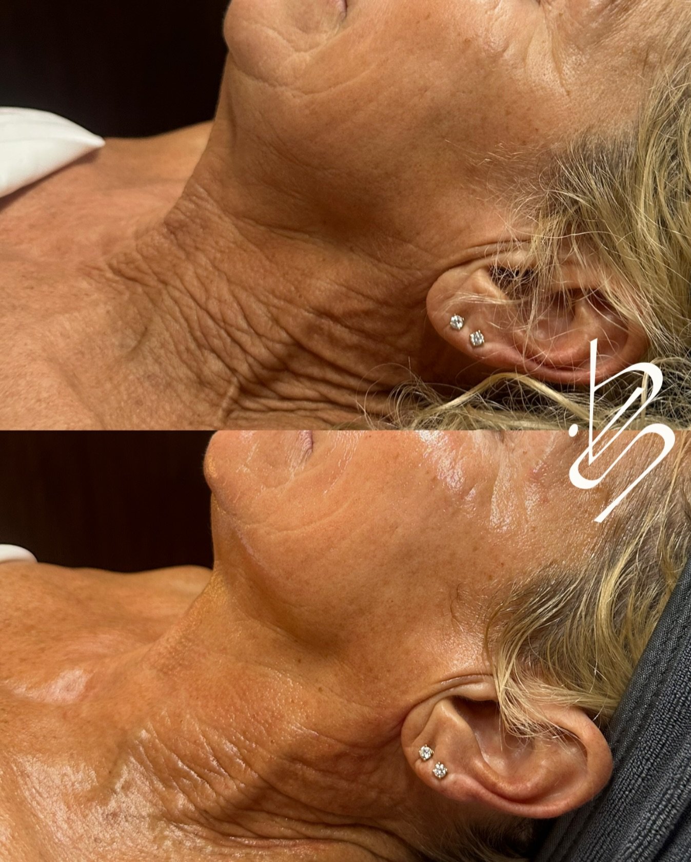 Floored with this client&rsquo;s results!! 🤯🤩 

Her main concerns were crepey skin, laxity and fine lines on her neck. This is after 1 Platinum Hydrafacial with Neck + Decollete add-on! We noticed a visible difference in texture, hydration and laxi