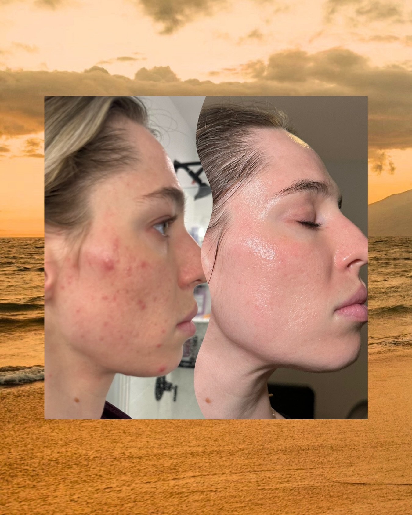 My own acne journey is the reason I became an esthetician.

There were several years when I avoided photos, constantly checked my skin in every mirror, doused my face in concealer, tried 372975 different products/medications/supplements praying somet