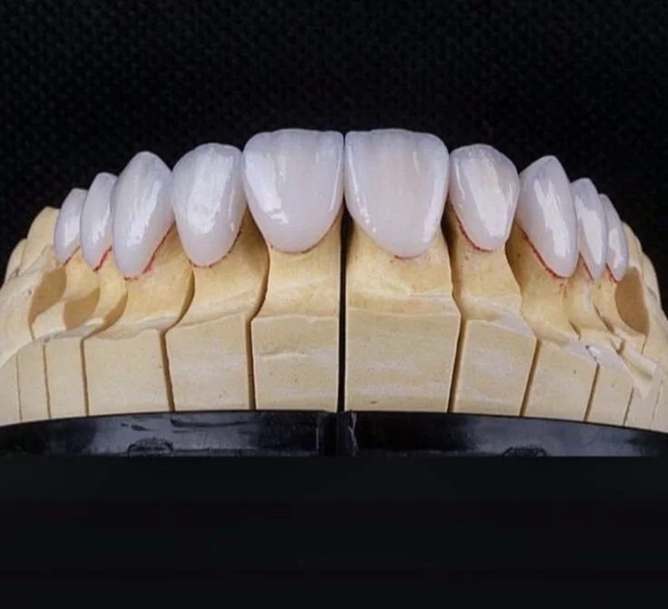 Full Set Of Veneers