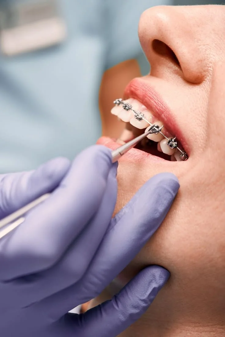 Traditional Metallic Braces