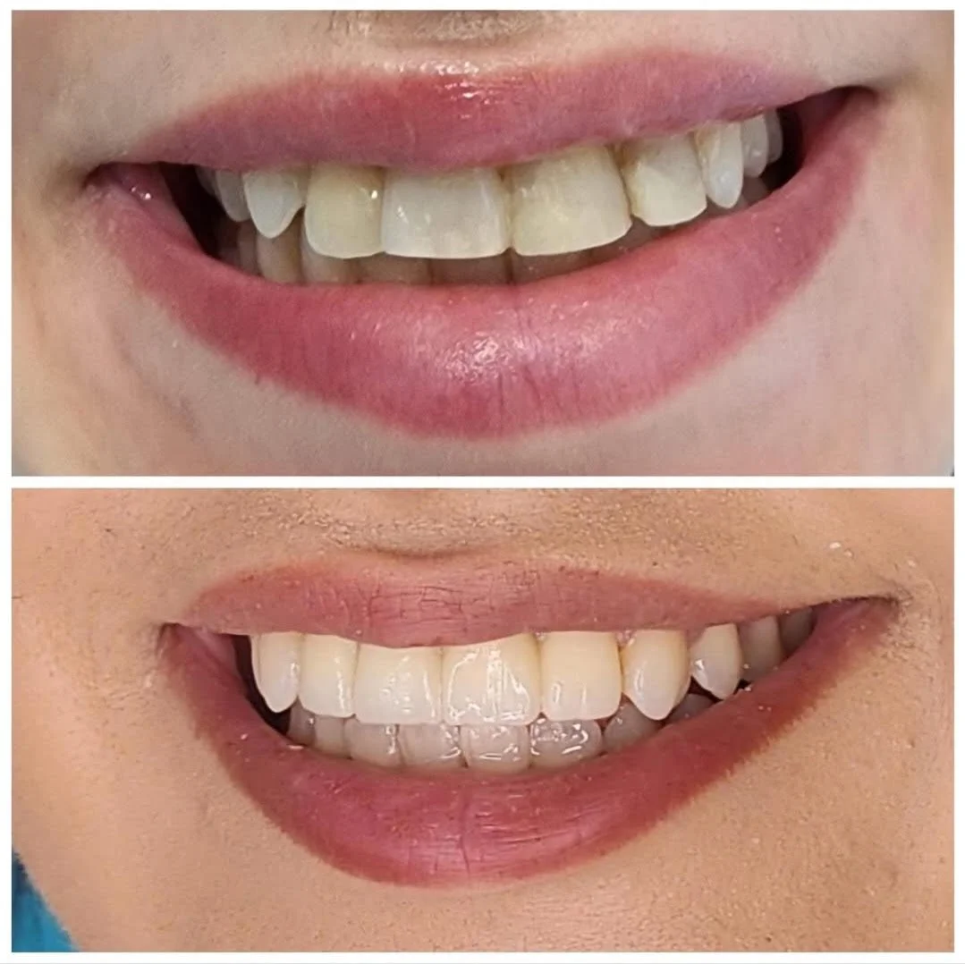 Comparison of two smiling mouths, the top showing teeth with slight discoloration and misalignment, the bottom showing teeth that are whiter and straighter.