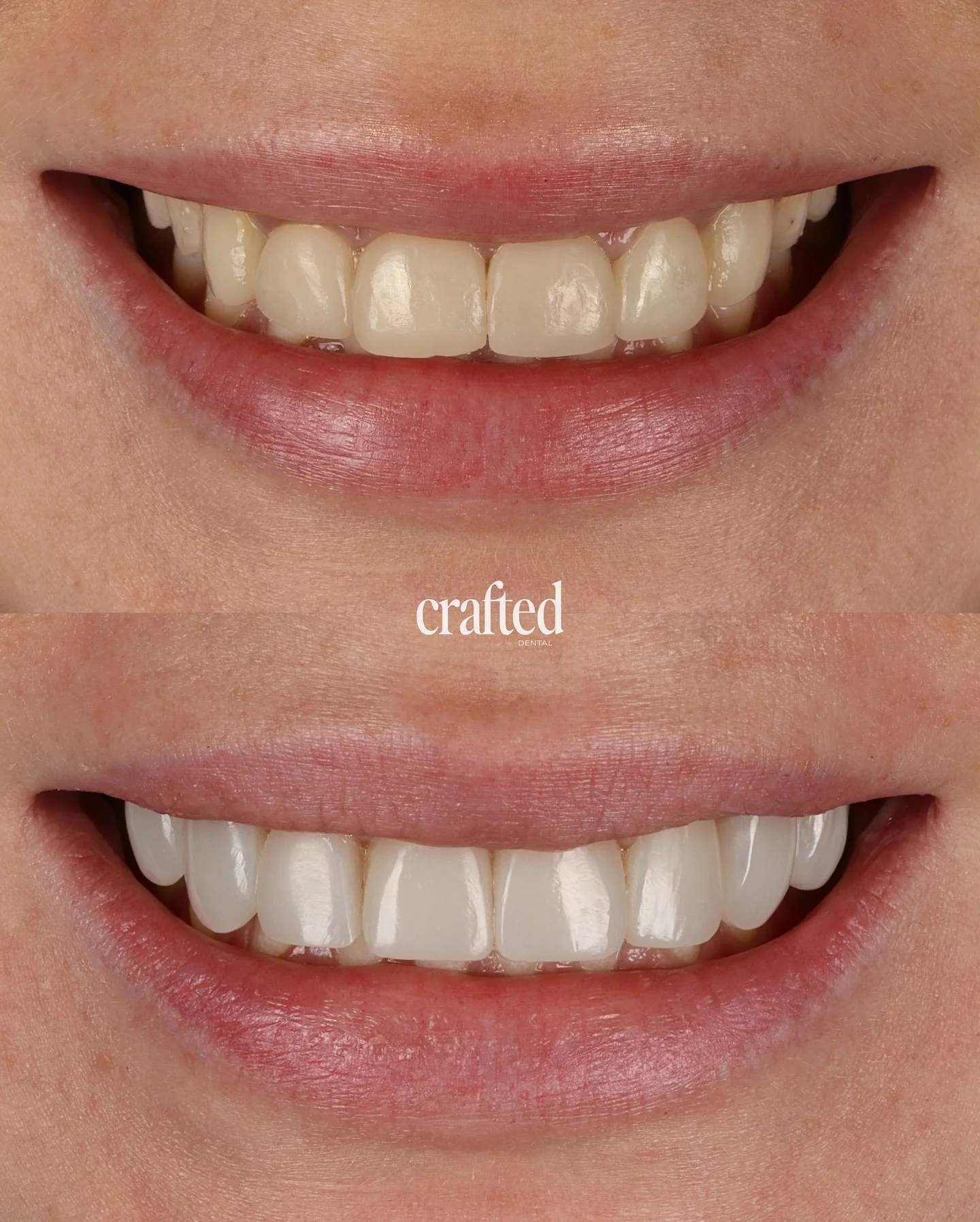 A complete smile refresh 🤍

This patient had previously had their porcelain veneers done twice, but was never fully happy with the result. They felt their front teeth looked too narrow, too short, and lacked the natural brightness they wanted. So th