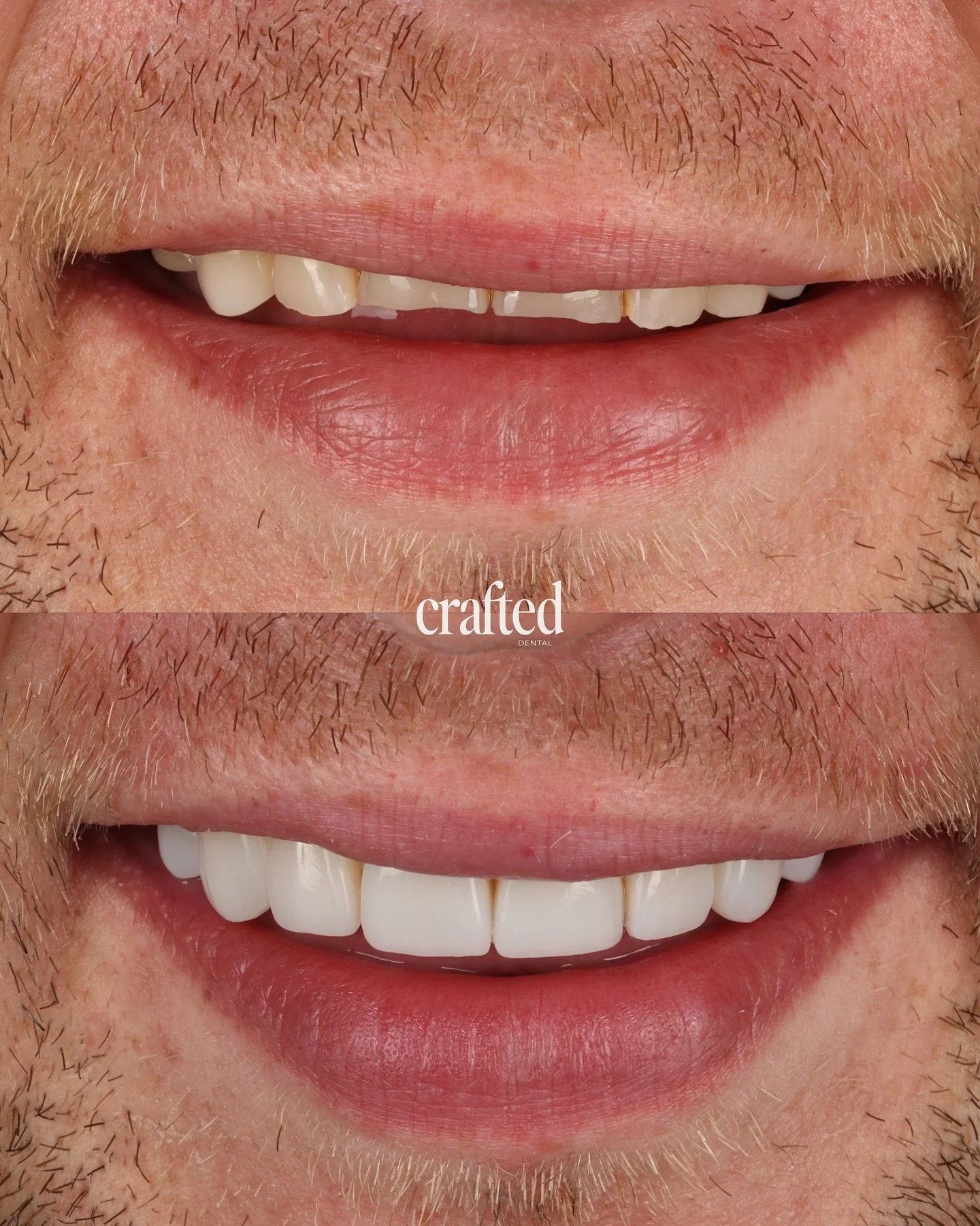 A truly transformative smile journey✨

This patient came to us feeling self-conscious about their smile due to wear, broken front teeth, discolouration, and a loss of length over time. After just a few weeks, everything changed.

Treatment: 3 Weeks o