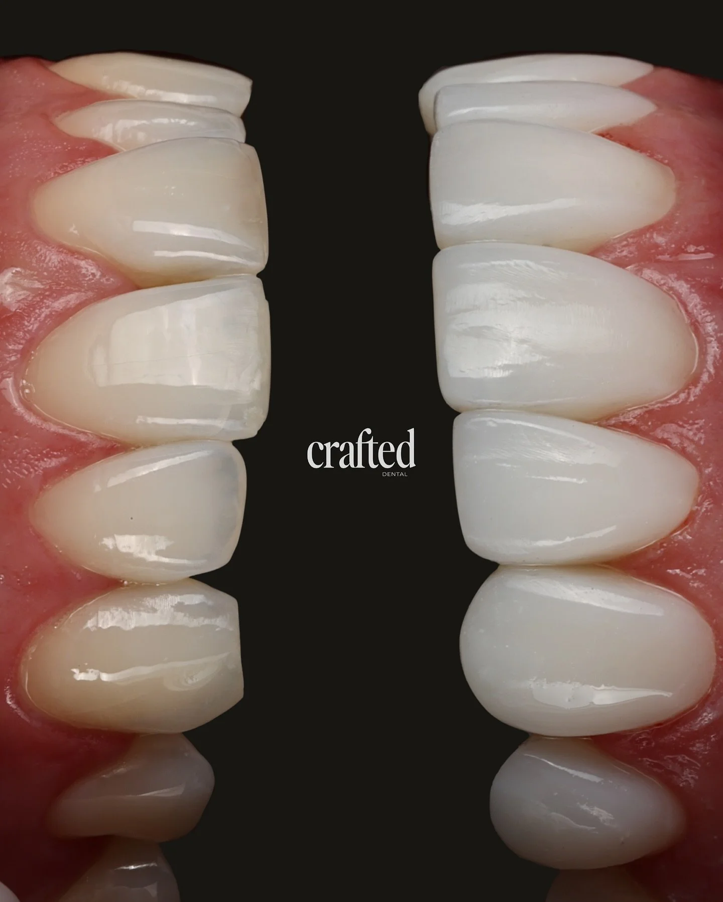 A beautifully bright and balanced smile ✨

This patient wanted to improve the shape and width of their smile while addressing wear on their teeth, specifically the canines. Through whitening and crafted bonding, we achieved a natural, harmonious resu